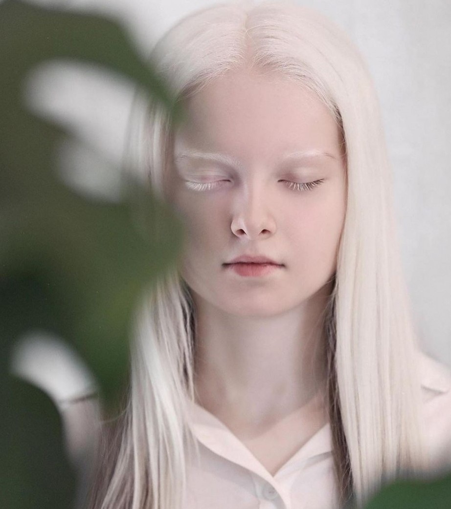 Amina Ependieva-虹膜異色症