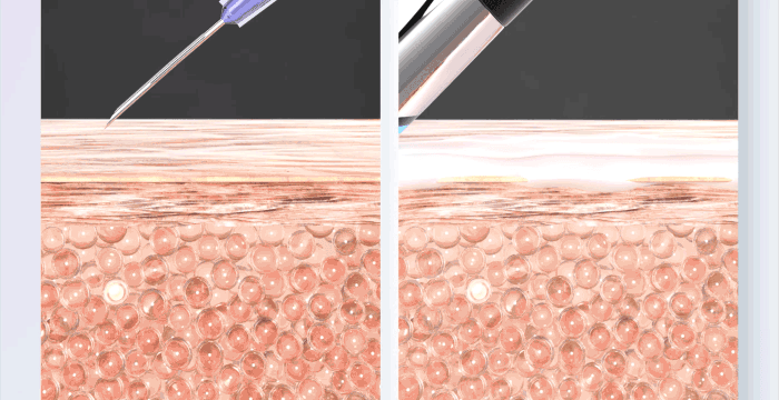 Age-R Booster H嶄新科技,在無針無痛無壓痕的情況,帶來注射式水光針療程修護之效。