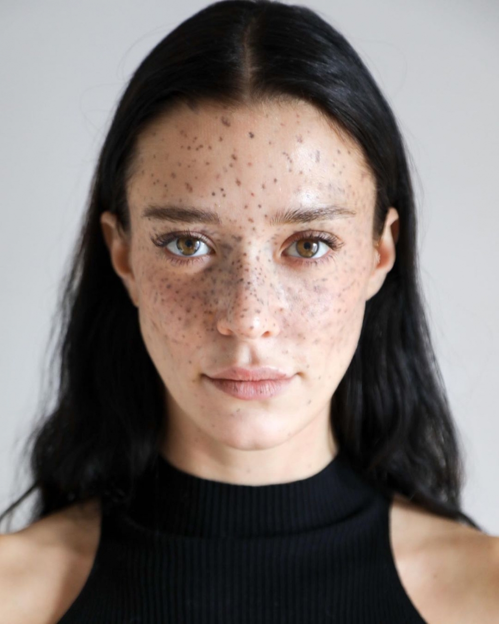 佈滿雀斑的臉蛋形成獨特的美麗