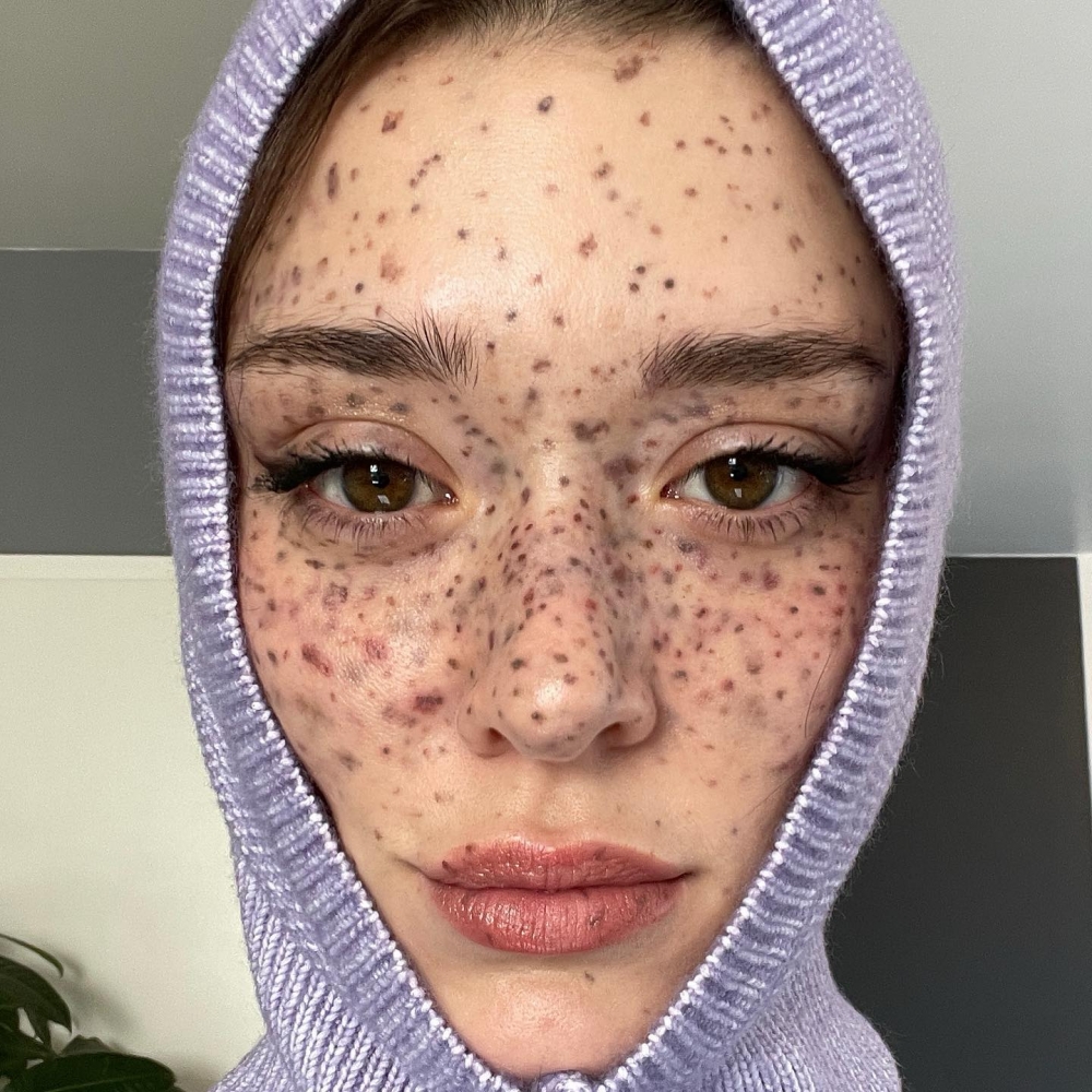 曾經認為雀斑是一種瑕疵