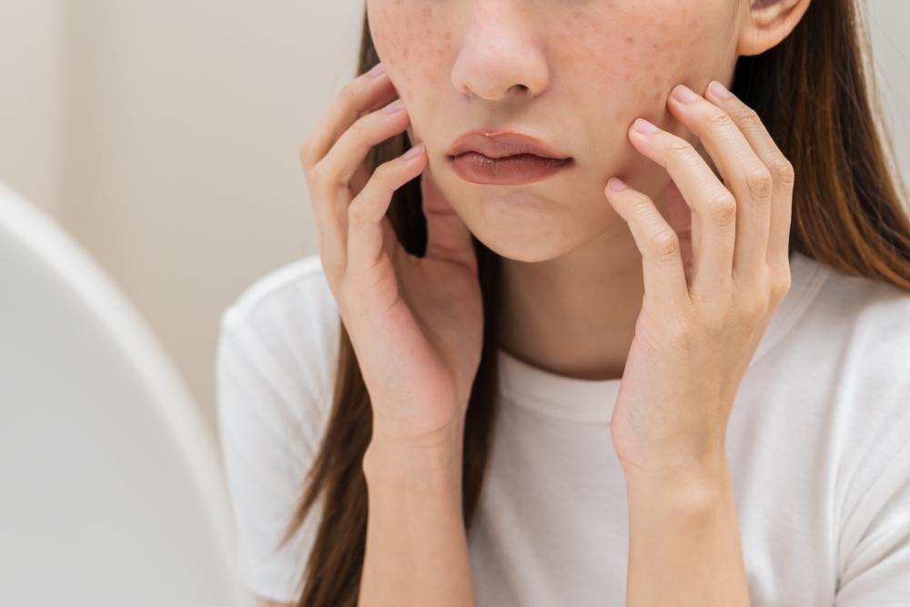 色斑分為「先天性」和「後天性」兩類：後者一般在學齡前就會出現，後者則多在青春期後才出現！