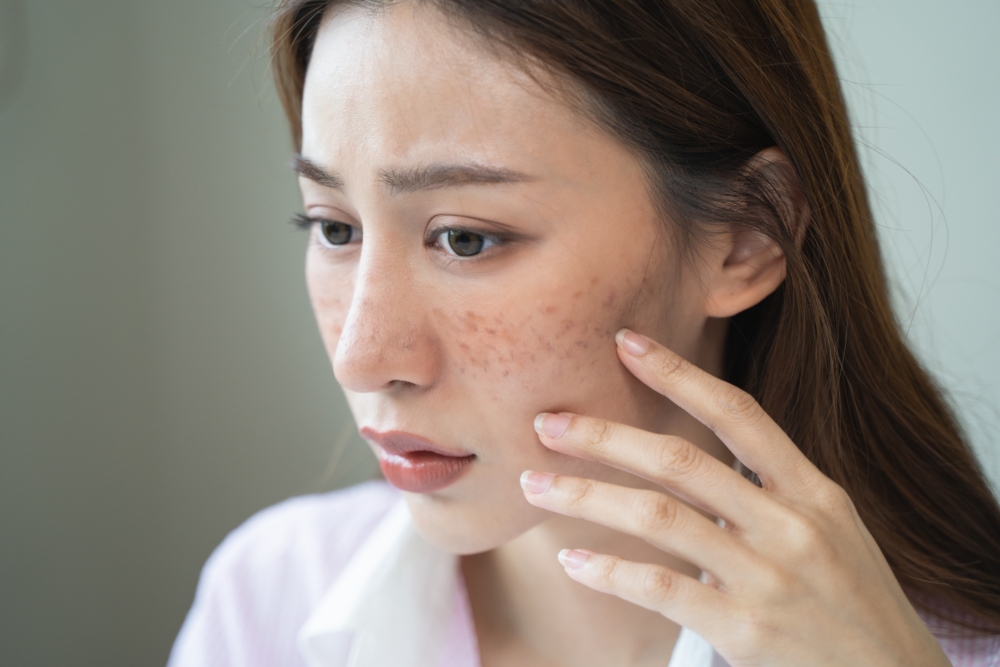 色斑是皮膚上因黑色素沉澱而形成的斑點，顏色從淺咖啡色到深褐色都有，有些更會帶點紅色！