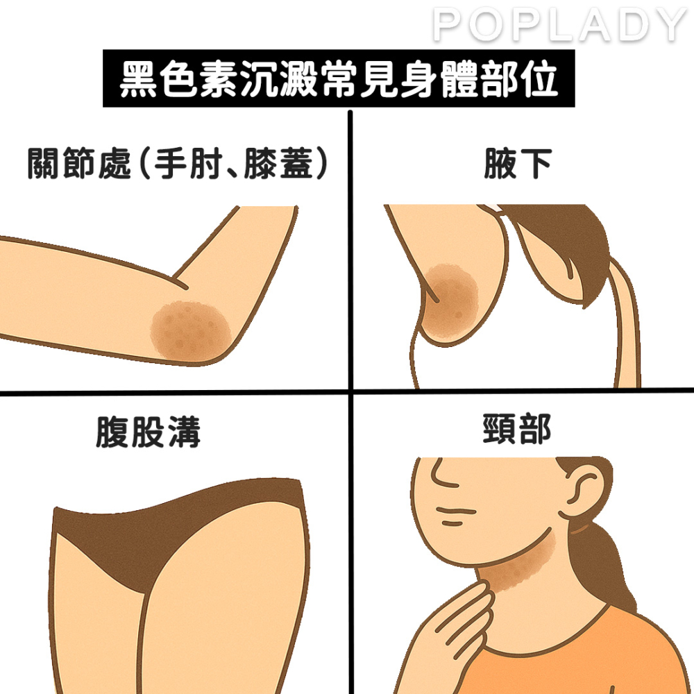黑色素沉澱不僅出現在臉部,身體出現黑色素沉澱的情況也很常見。