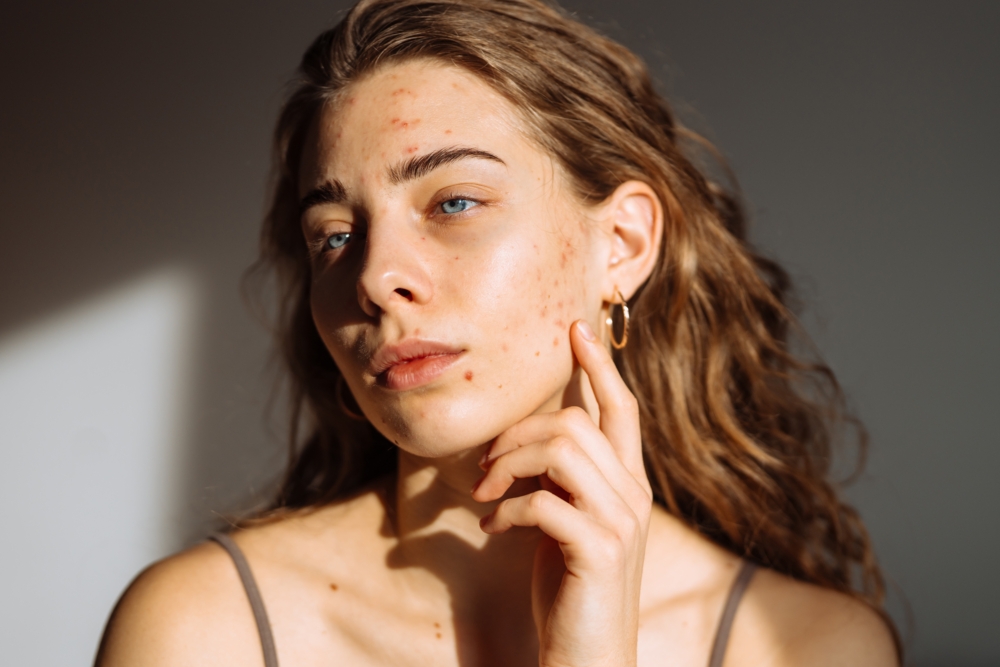 在討論如何去斑和黑色素之前，先認識常見的斑點類型以及形成原因，有助於對症下藥。