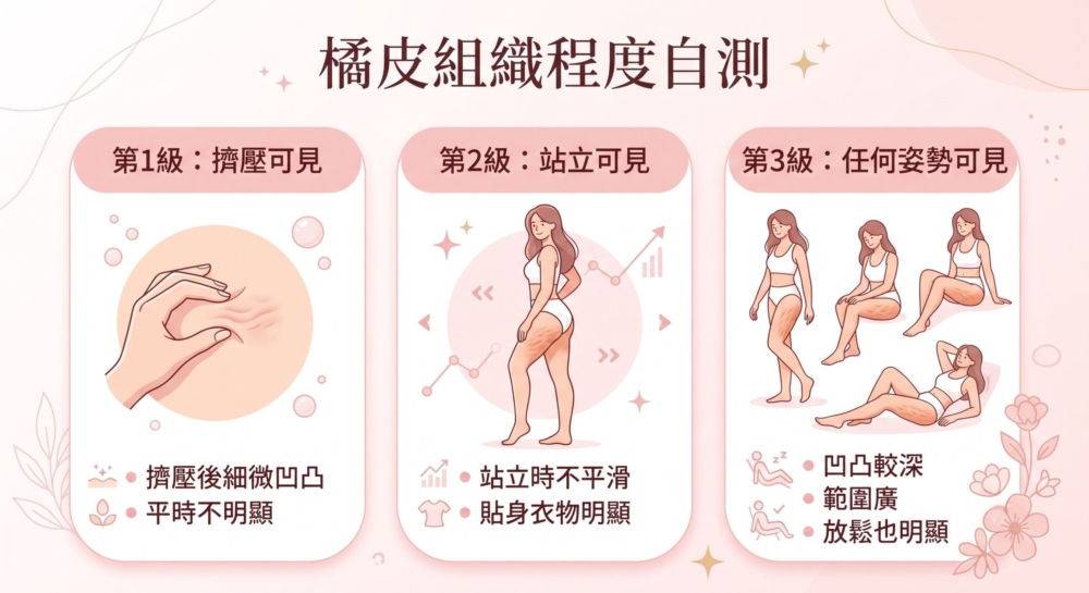 一張資訊圖表列出了「橘皮組織程度自測」。圖表以三個等級說明橘皮組織的嚴重程度：第1級（擠壓可見）、第2級（站立可見）和第3級（任何姿勢可見）